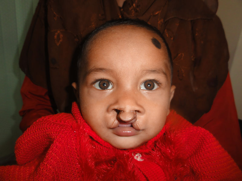 Causes of cleft